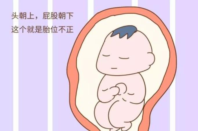 宝宝胎位不正怎么办?教你几招及时矫正